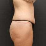 Tummy Tuck Case 6870, After Treatment, Female Patient, Thumbnail 3