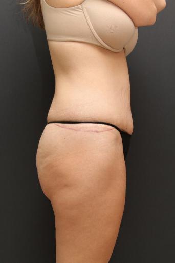 Tummy Tuck Case 6870, After Treatment, Female Patient, Set 3