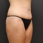 Tummy Tuck Case 6870, After Treatment, Female Patient, Thumbnail 2