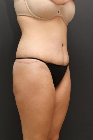 Tummy Tuck Case 6870, After Treatment, Female Patient, Set 2