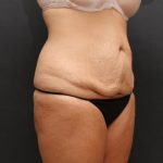 Tummy Tuck Case 6870, Before Treatment, Female Patient, Thumbnail 2
