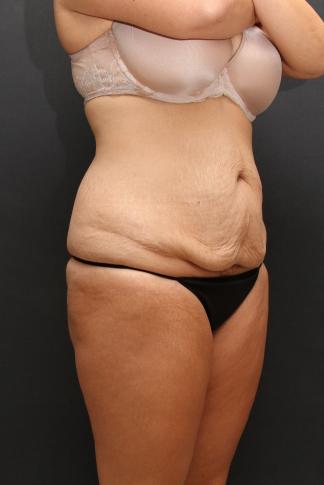 Tummy Tuck Case 6870, Before Treatment, Female Patient, Set 2
