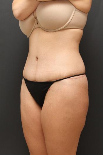 Tummy Tuck Case 6870, After Treatment, Female Patient, Set 4
