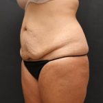 Tummy Tuck Case 6870, Before Treatment, Female Patient, Thumbnail 4