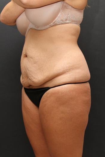 Tummy Tuck Case 6870, Before Treatment, Female Patient, Set 4