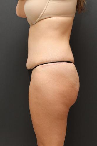 Tummy Tuck Case 6870, After Treatment, Female Patient, Set 5