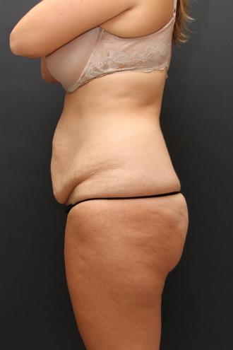 Tummy Tuck Case 6870, Before Treatment, Female Patient, Set 5