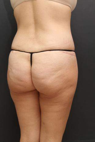 Tummy Tuck Case 6870, After Treatment, Female Patient, Set 6