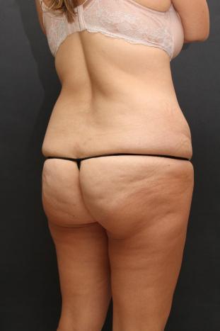 Tummy Tuck Case 6870, Before Treatment, Female Patient, Set 6