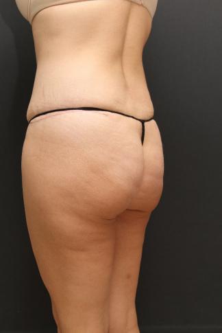 Tummy Tuck Case 6870, After Treatment, Female Patient, Set 7