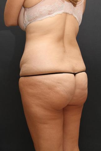 Tummy Tuck Case 6870, Before Treatment, Female Patient, Set 7