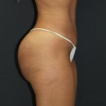 Tummy Tuck Case 6871, After Treatment, Female Patient, Thumbnail 2