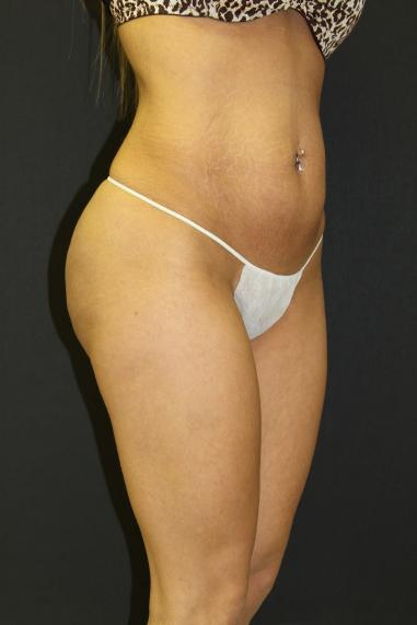 Tummy Tuck Case 6871, Before Treatment, Female Patient, Set 3