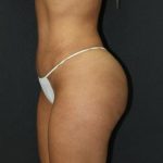 Tummy Tuck Case 6871, After Treatment, Female Patient, Thumbnail 5