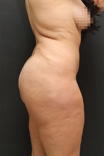 Tummy Tuck Case 6872, After Treatment, Female Patient, Set 3