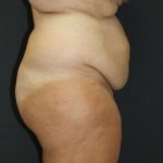 Tummy Tuck Case 6872, Before Treatment, Female Patient, Thumbnail 3