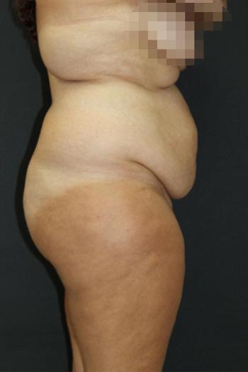 Tummy Tuck Case 6872, Before Treatment, Female Patient, Set 3