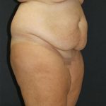 Tummy Tuck Case 6872, Before Treatment, Female Patient, Thumbnail 2