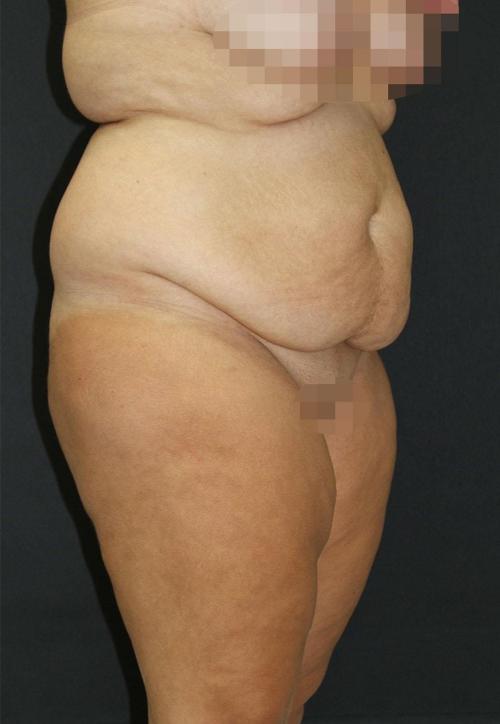Tummy Tuck Case 6872, Before Treatment, Female Patient, Set 2