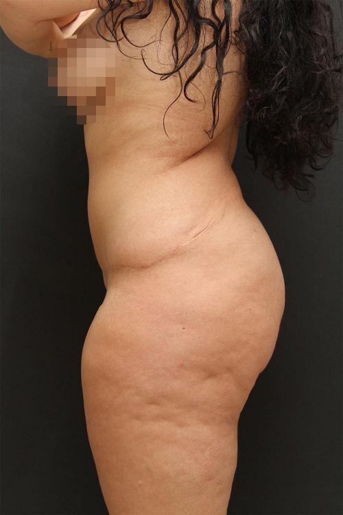 Tummy Tuck Case 6872, After Treatment, Female Patient, Set 4