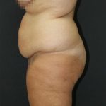 Tummy Tuck Case 6872, Before Treatment, Female Patient, Thumbnail 4