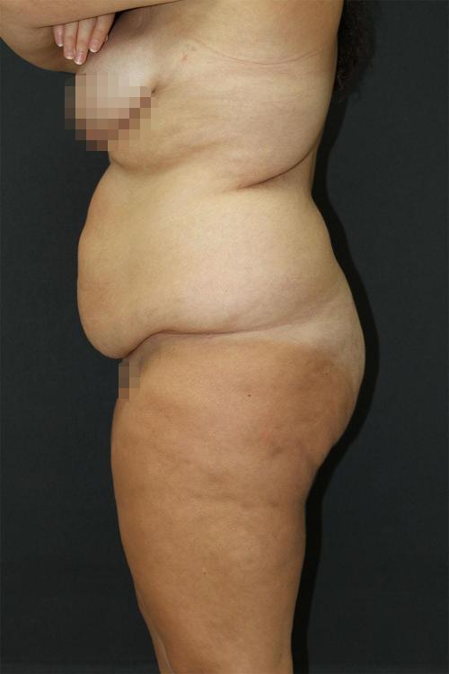 Tummy Tuck Case 6872, Before Treatment, Female Patient, Set 4