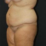 Tummy Tuck Case 6872, Before Treatment, Female Patient, Thumbnail 5