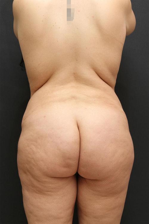Tummy Tuck Case 6872, After Treatment, Female Patient, Set 8