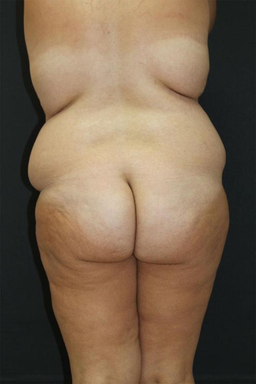 Tummy Tuck Case 6872, Before Treatment, Female Patient, Set 8