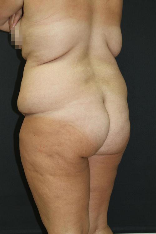 Tummy Tuck Case 6872, Before Treatment, Female Patient, Set 6