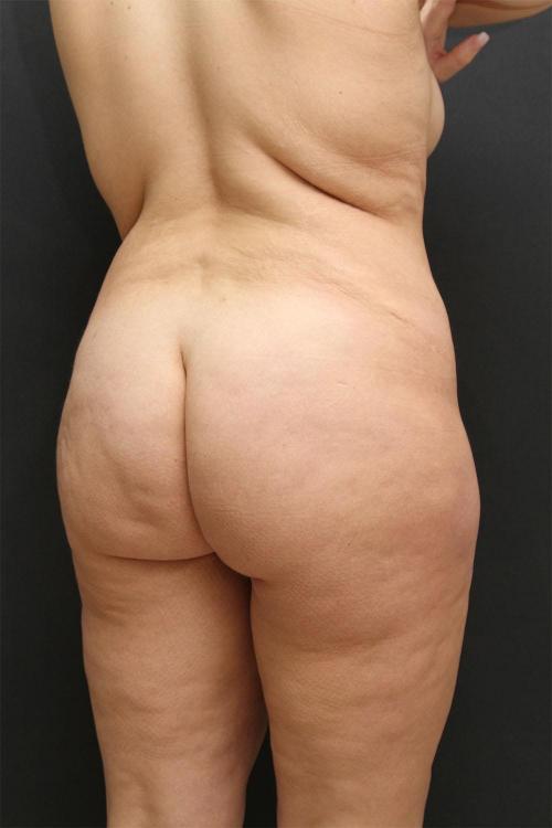 Tummy Tuck Case 6872, After Treatment, Female Patient, Set 7