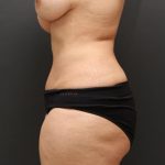 Tummy Tuck Case 6873, After Treatment, Female Patient, Thumbnail 3