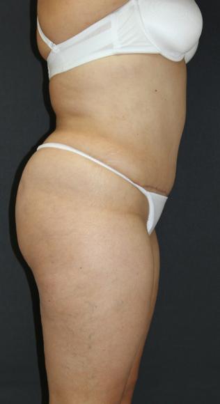 Tummy Tuck Case 6875, After Treatment, Female Patient, Set 3