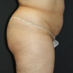 Tummy Tuck Case 6875, Before Treatment, Female Patient, Thumbnail 3