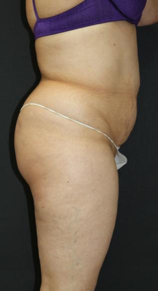 Tummy Tuck Case 6875, Before Treatment, Female Patient, Set 3