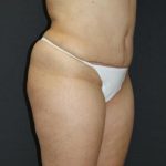 Tummy Tuck Case 6875, After Treatment, Female Patient, Thumbnail 2