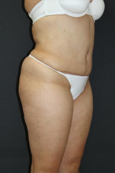 Tummy Tuck Case 6875, After Treatment, Female Patient, Set 2