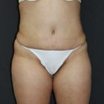 Tummy Tuck Case 6875, After Treatment, Female Patient, Thumbnail 1