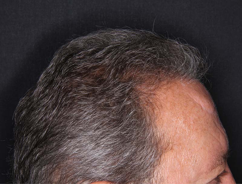 Hair Restoration After Photo