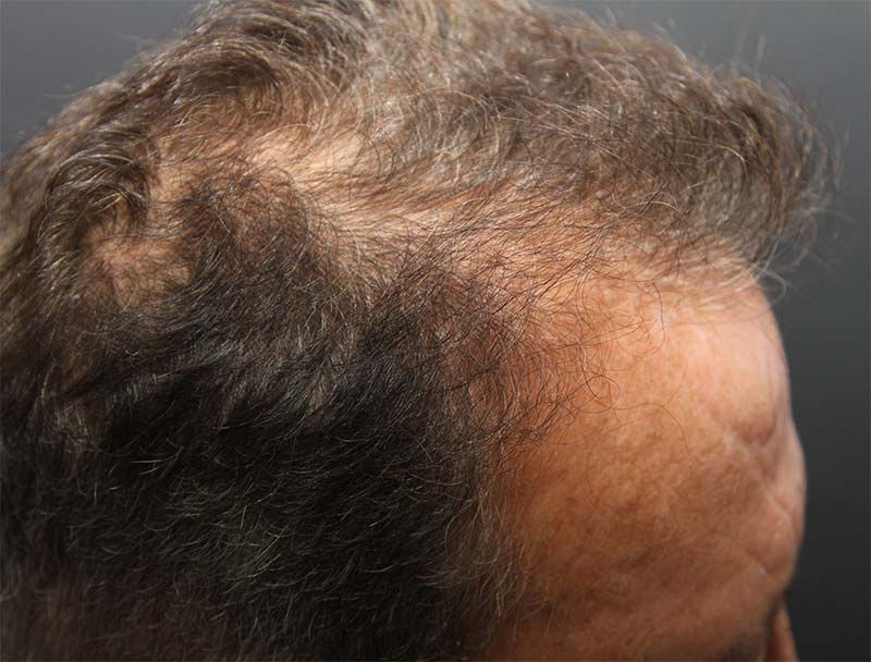 Hair Restoration Before Photo