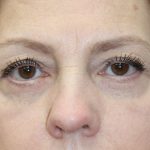 Eyelid and Brow Enhancement Case 6733, After Treatment, Female Patient, Thumbnail 1