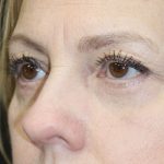 Eyelid and Brow Enhancement Case 6733, After Treatment, Female Patient, Thumbnail 2
