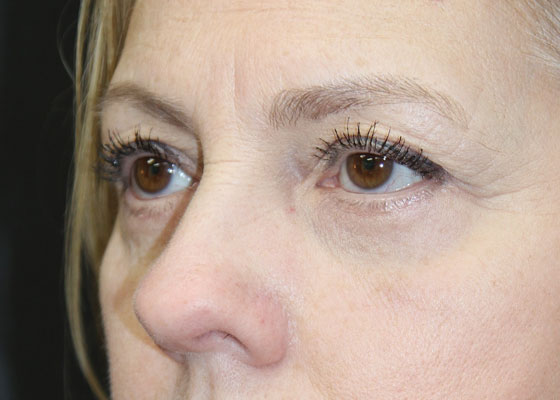 Eyelid and Brow Enhancement Case 6733, After Treatment, Female Patient, Set 2