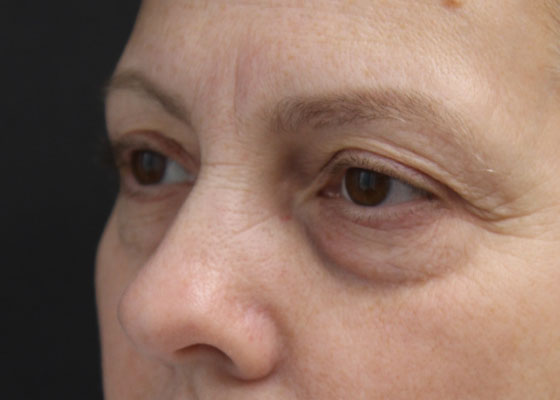 Eyelid and Brow Enhancement Case 6733, Before Treatment, Female Patient, Set 2